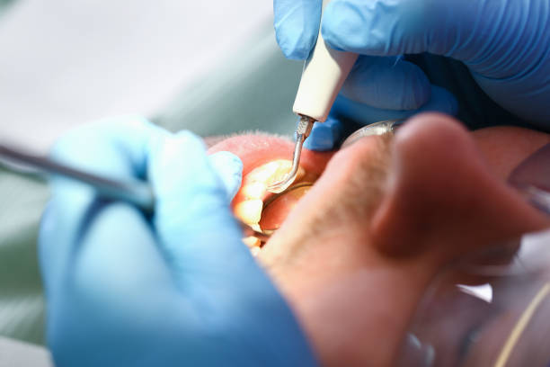 Best Emergency Tooth Extraction in Benbrook, TX